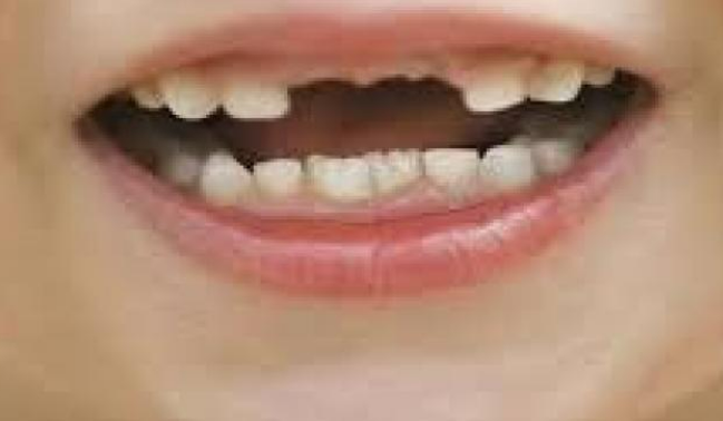 تفسير حلم وقوع الاسنان 